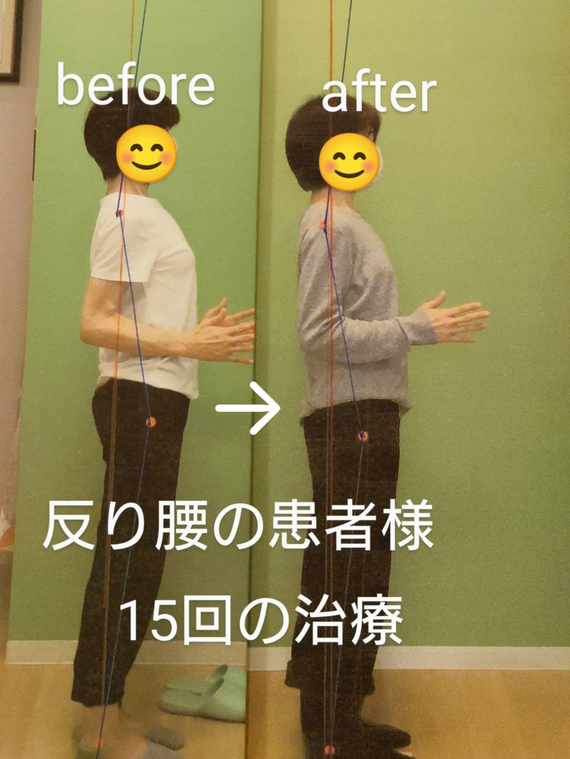骨盤矯正によるbefore & after - てんま整骨鍼灸院